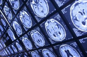 SD Traumatic Brain Injury